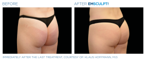 Emsculpt NEO: Melt Fat, Build Muscle and Tone Body in Miami